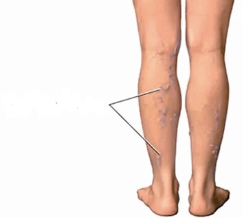 Consequences of knee artosis