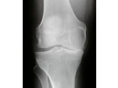 Diagnosis of arterry of knee joint