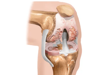 artrosis or arthritis of differences