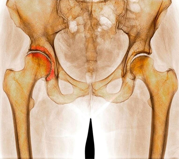Artrosis of hip joint