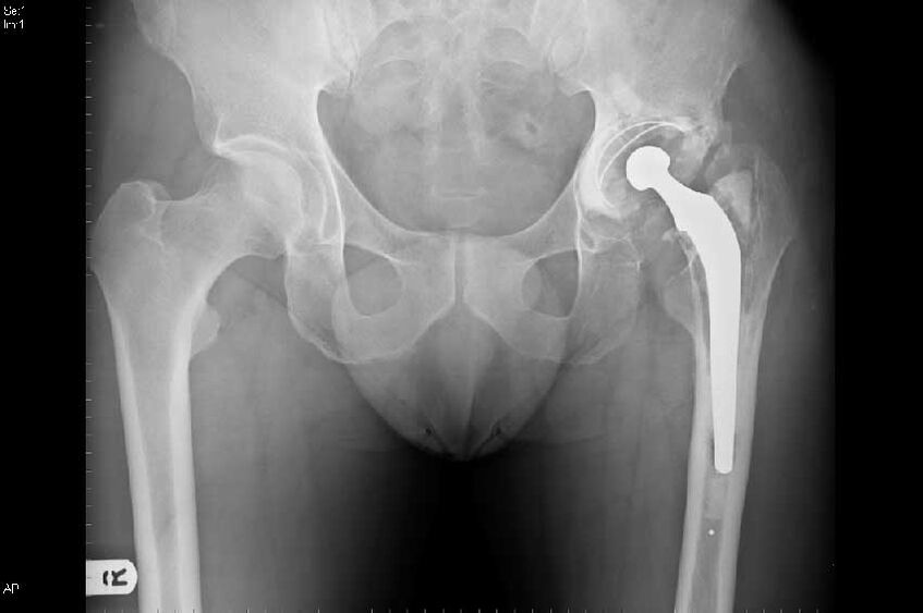 Coksarthrosis