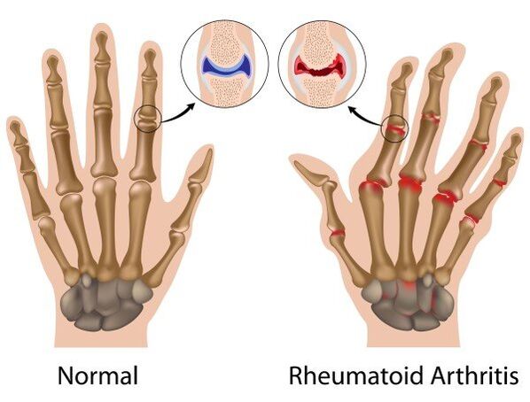Fingers units of non-pathological and rheumatoid arthritis