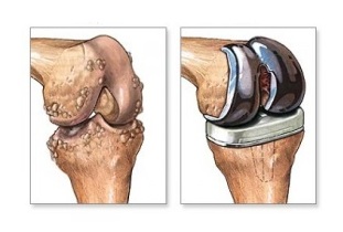 Replacing the knee for osteoarthritis