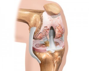 early stage of knee osteoarthritis