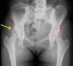 Methods of treatment of arthrosis of hip combination