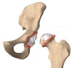 Reasons for the development of arthrosis of hip combination
