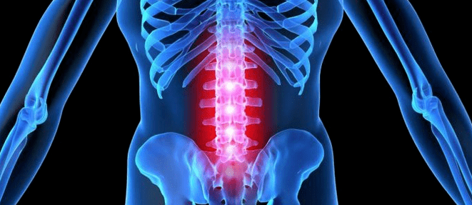 Deformation of intervertebral disk