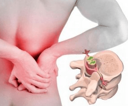 Osteocondrosis at the beginning of lumbago disease