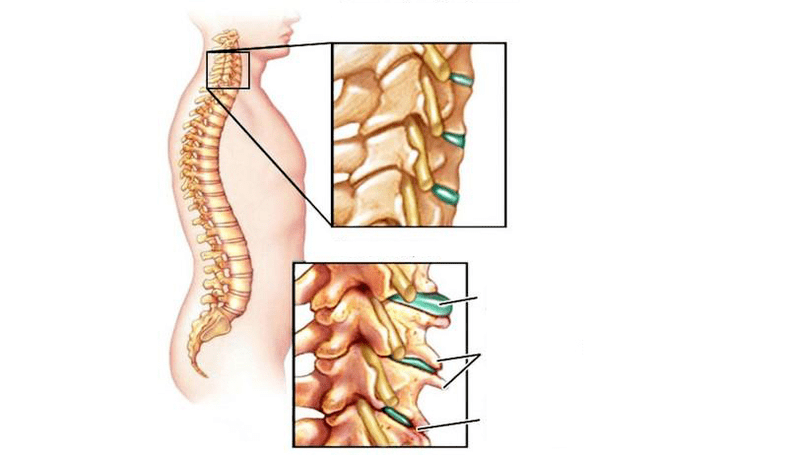 Osteocondrosis syndromes