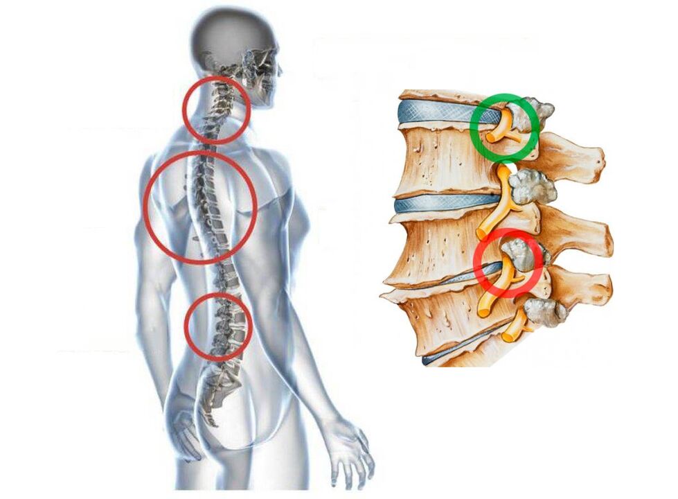 What does vertebrae's cervical osteocondrosis look like