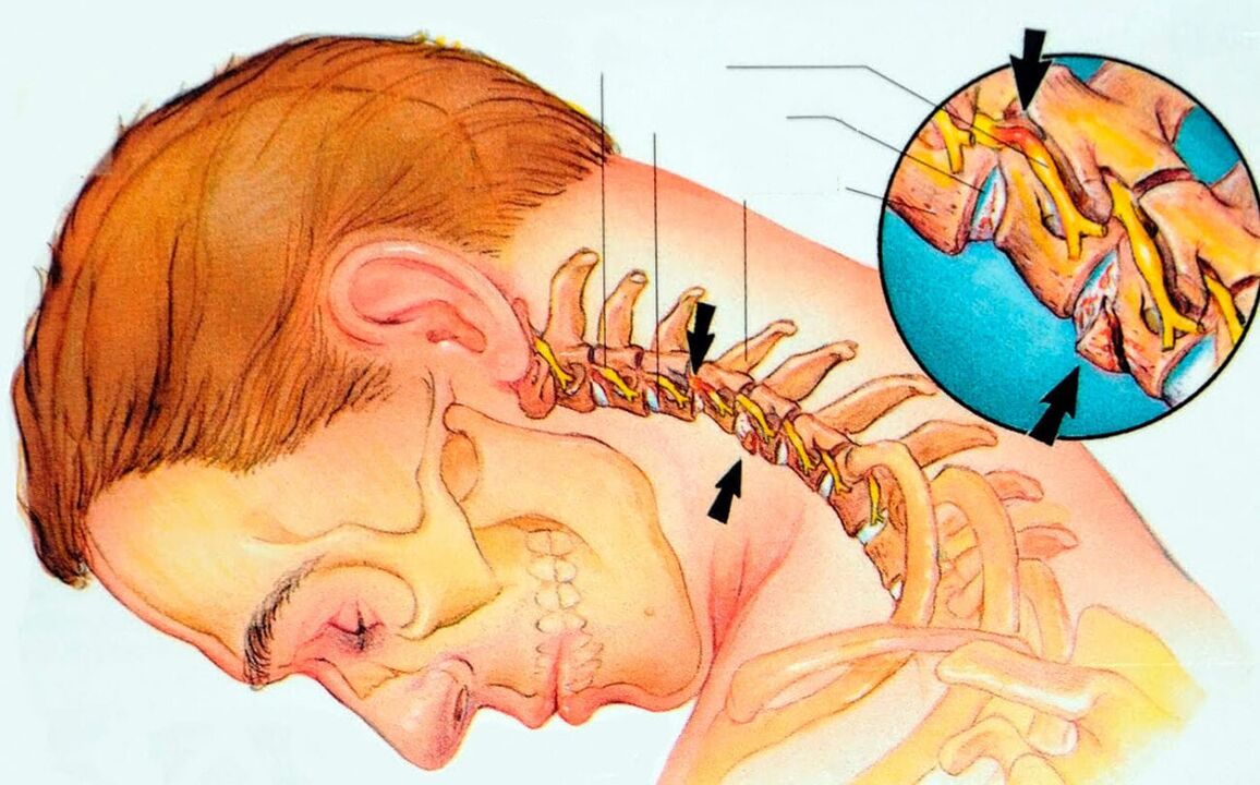 What is cervical osteocondrosis