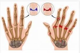 Differences between the arthritis and arthrosis of hands