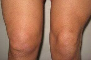 Inflammation in knee joint with arthritis and arthrosis
