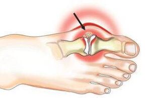 Joint damage due to arthritis and arthrosis