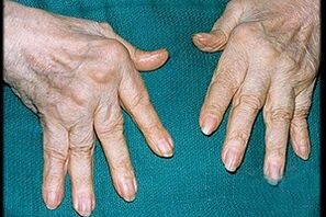 arthritis symptoms on the fingers