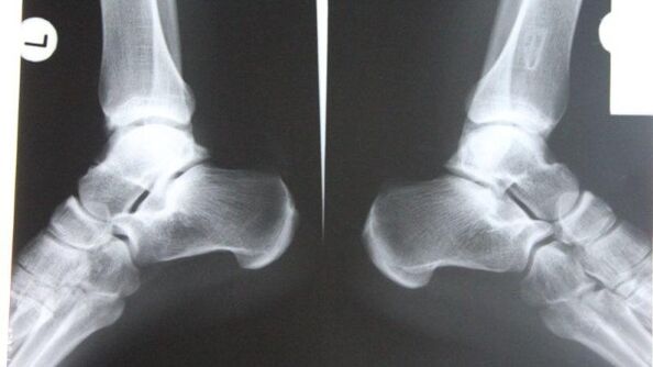 Diagnosis of ankle arthrosis using radiography