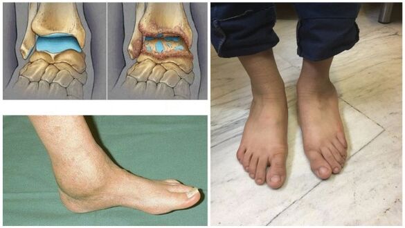 Swelling and deformation of the ankle joint due to arthrosis