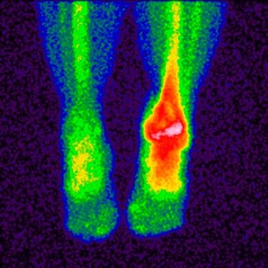 The method of differential diagnosis of crosarthrosis is scintigraphy