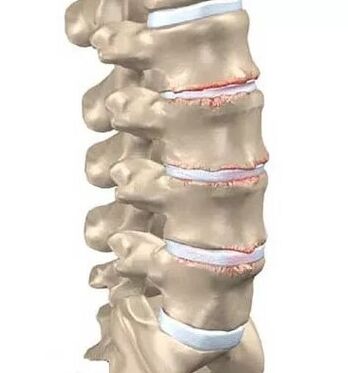 Osteocondrosis